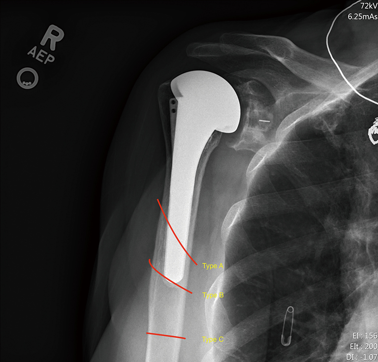 Periprosthetic Humerus Fractures Classification Management And Review Of The Literature Gebrelul Annals Of Joint