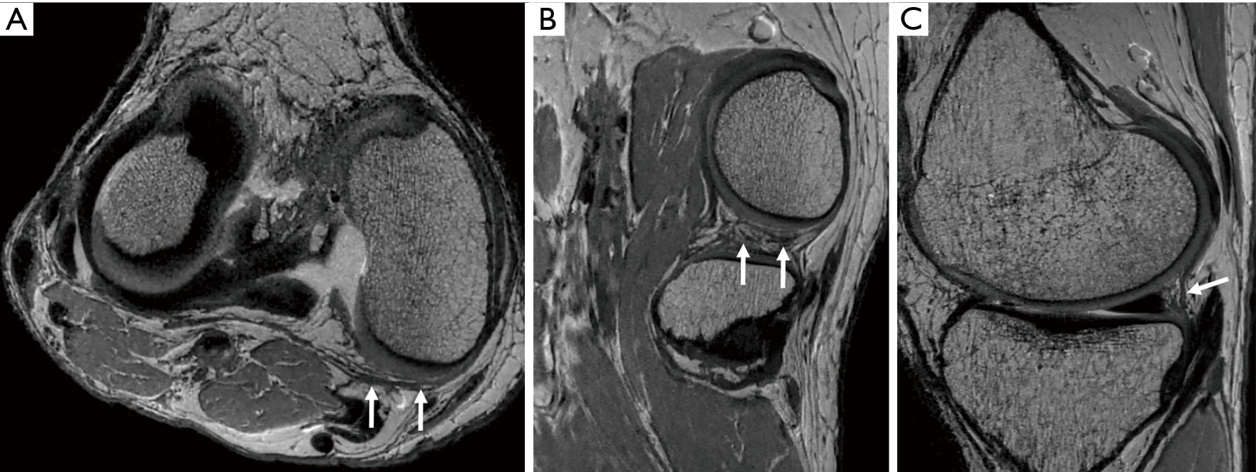 Imaging Evaluation Of The Multiligament Injured Knee Helito Annals Of Joint