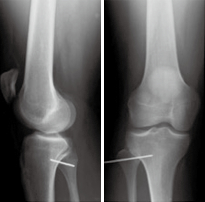Acute proximal tibiofibular joint dislocation: a sports related injury