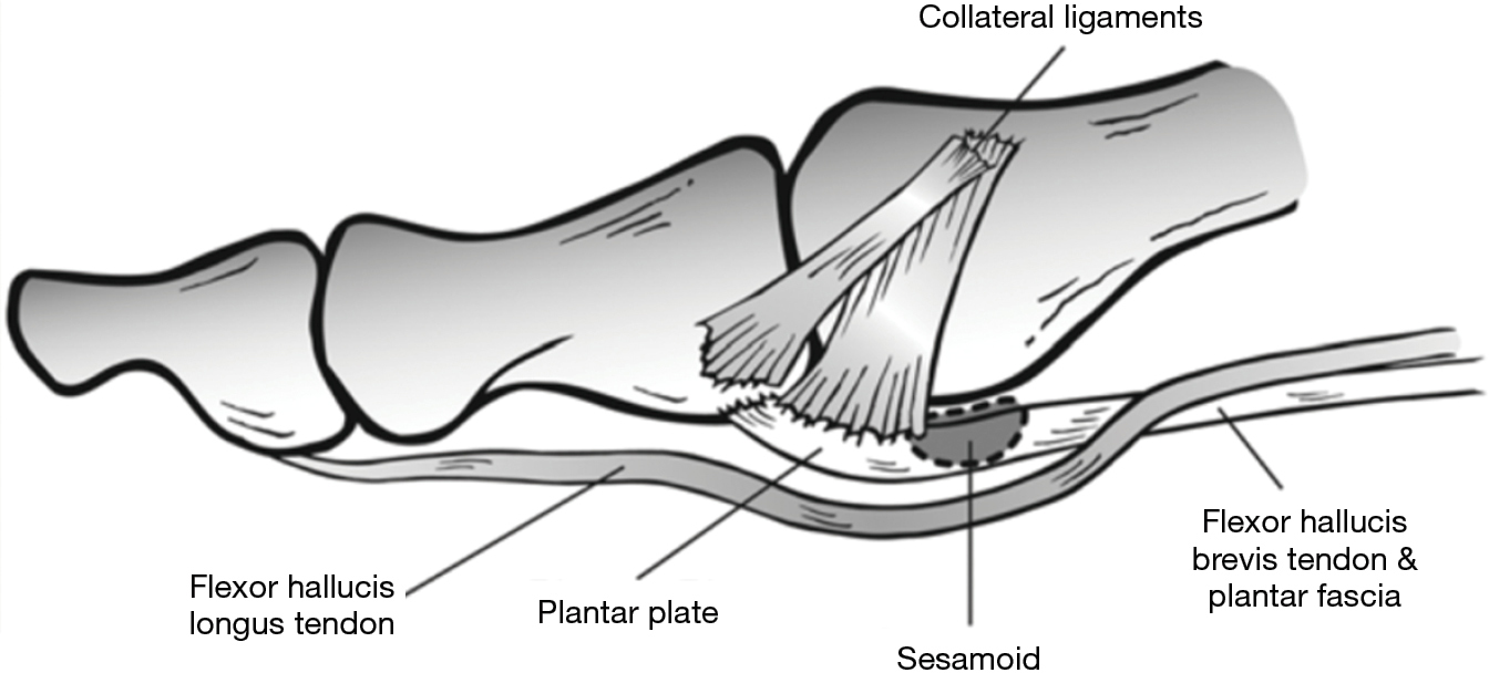 Turf toe: review of the literature and surgical technique - Fraser - Annals of Joint