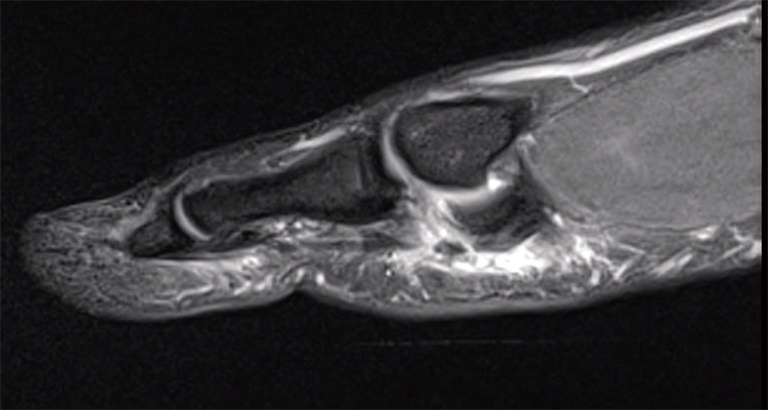 Turf toe: review of the literature and surgical technique - Fraser - Annals of Joint