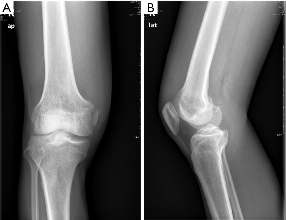 Avulsion fracture of femoral attachment of posterior cruciate ligament