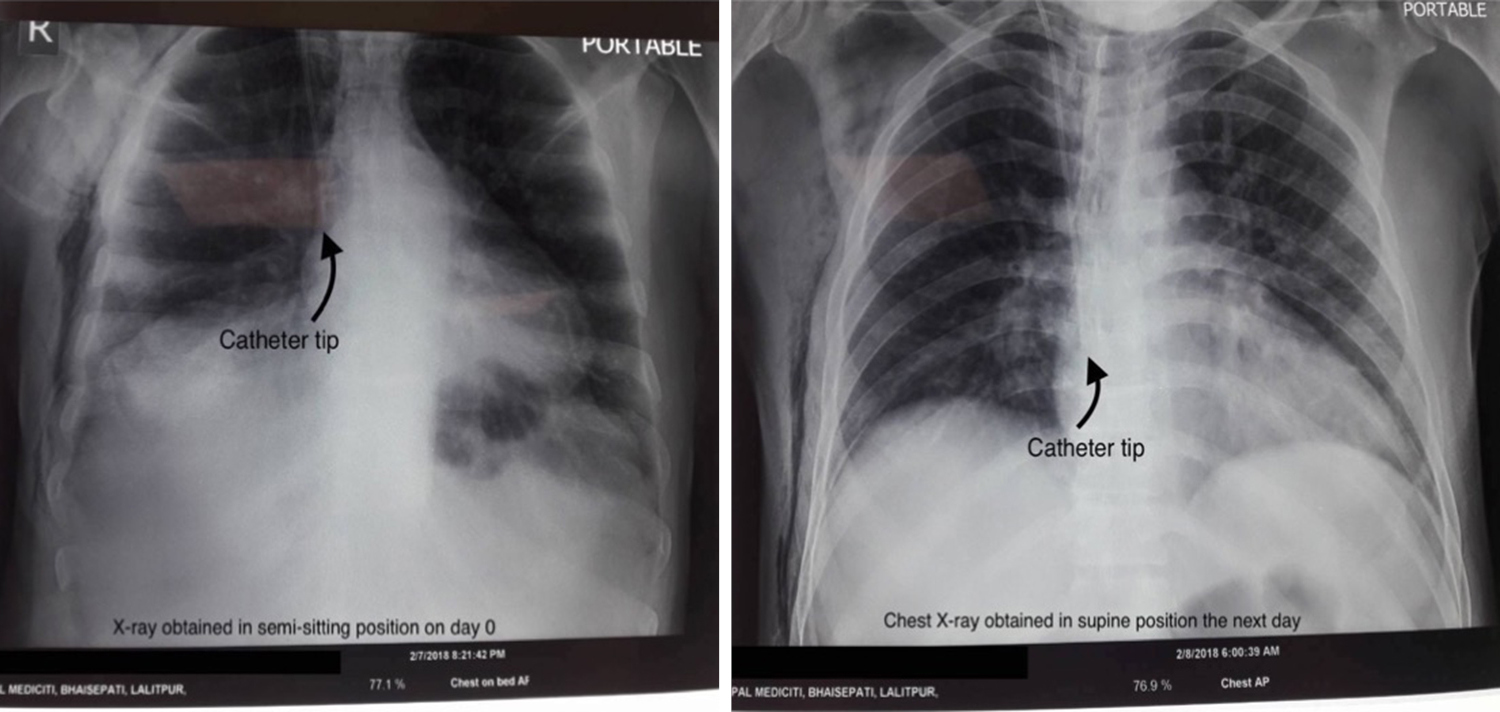 Is chest Xray in supine position for central lines confirmation a gold