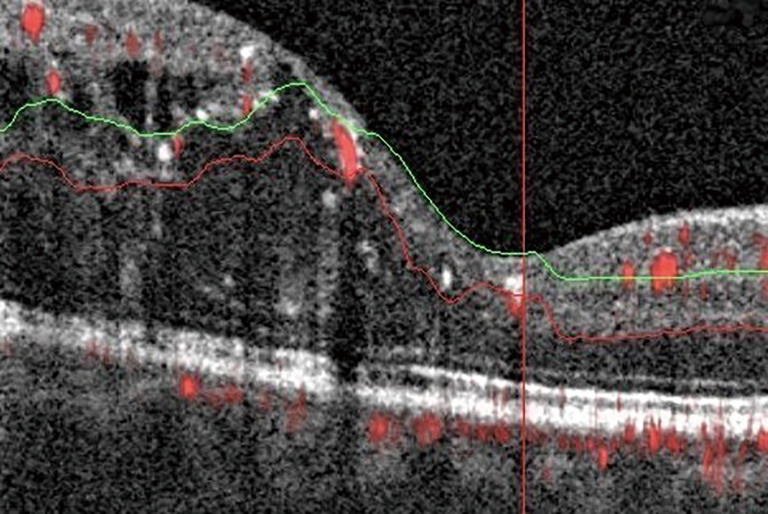 New Findings And Challenges In Oct Angiography For Diabetic Retinopathy Sorour Annals Of Eye Science