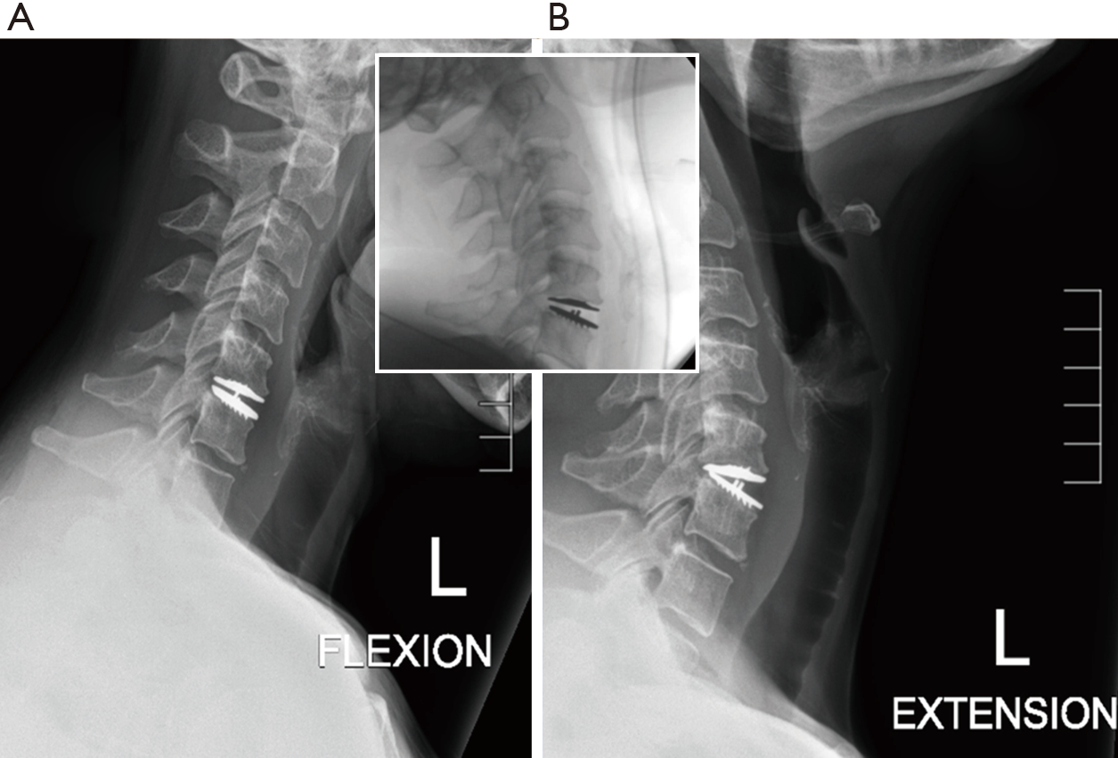 Focal Hypermobility Observed In Cervical Arthroplasty With Mobi C Kerferd Journal Of Spine Surgery