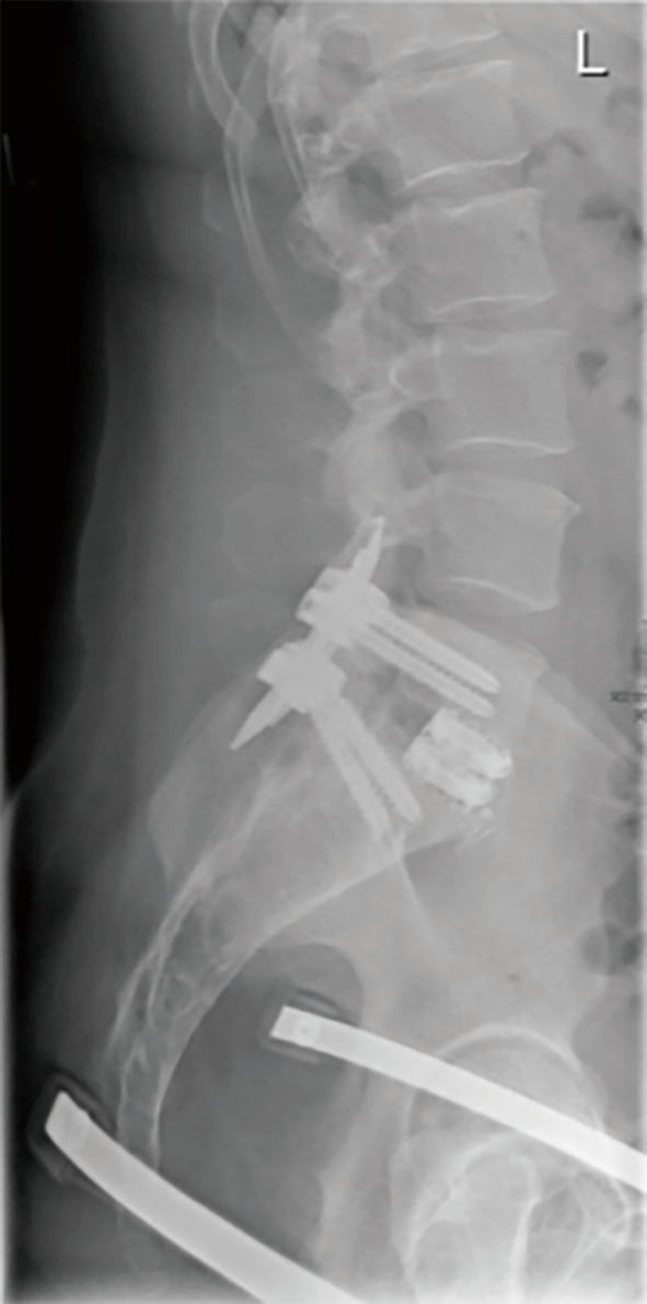 Disc herniation caused by a viscoelastic nucleus after total lumbar disc replacement—a case ...