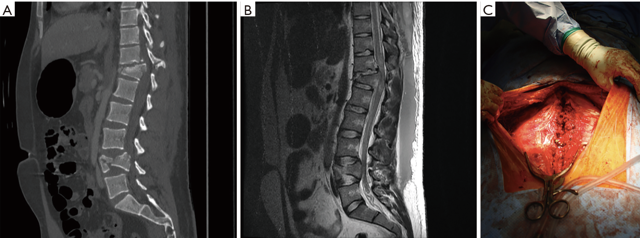 The Morel-Lavallée lesion in thoracolumbar spine trauma—two index cases