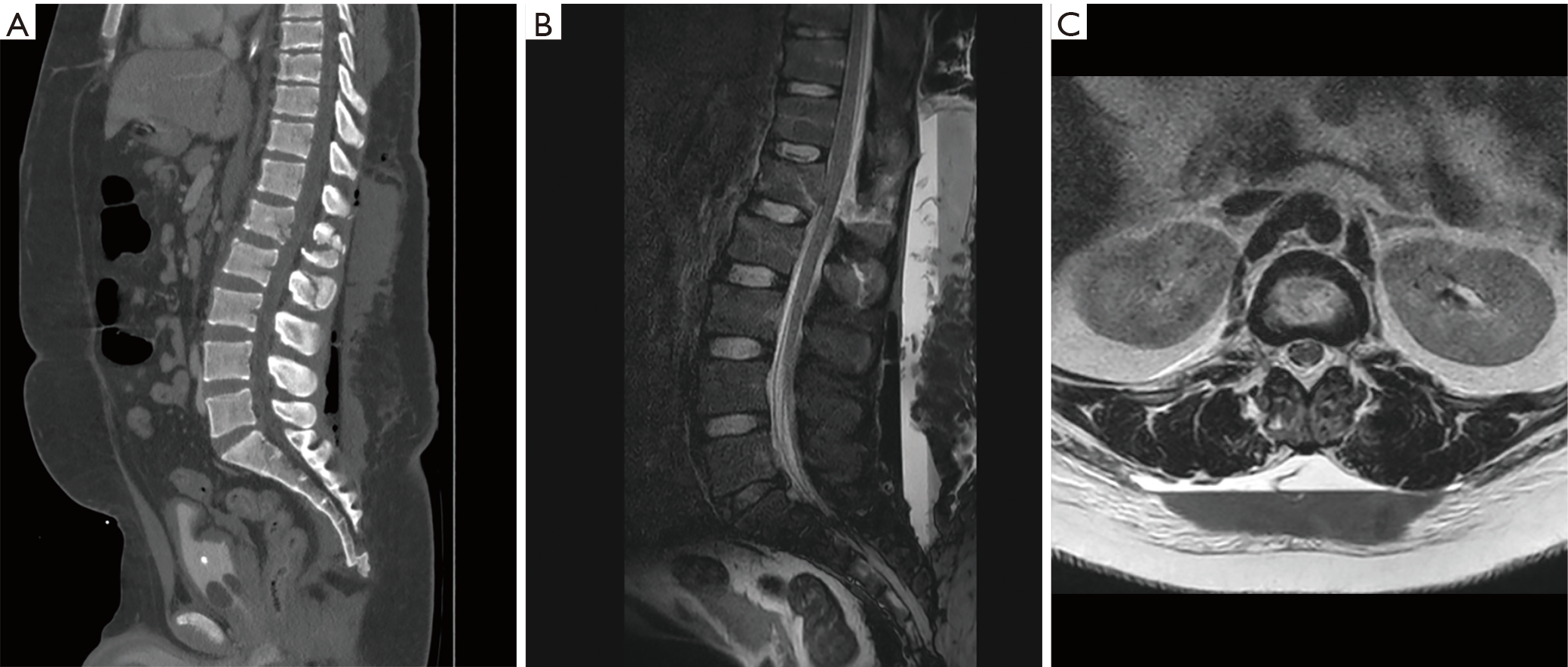 The MorelLavallée lesion in thoracolumbar spine trauma—two index cases