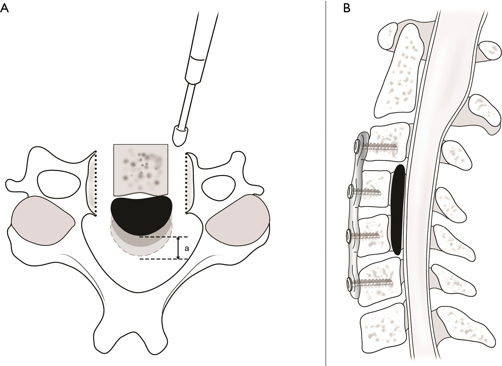 A novel anterior technique for kyphosis line (Kline