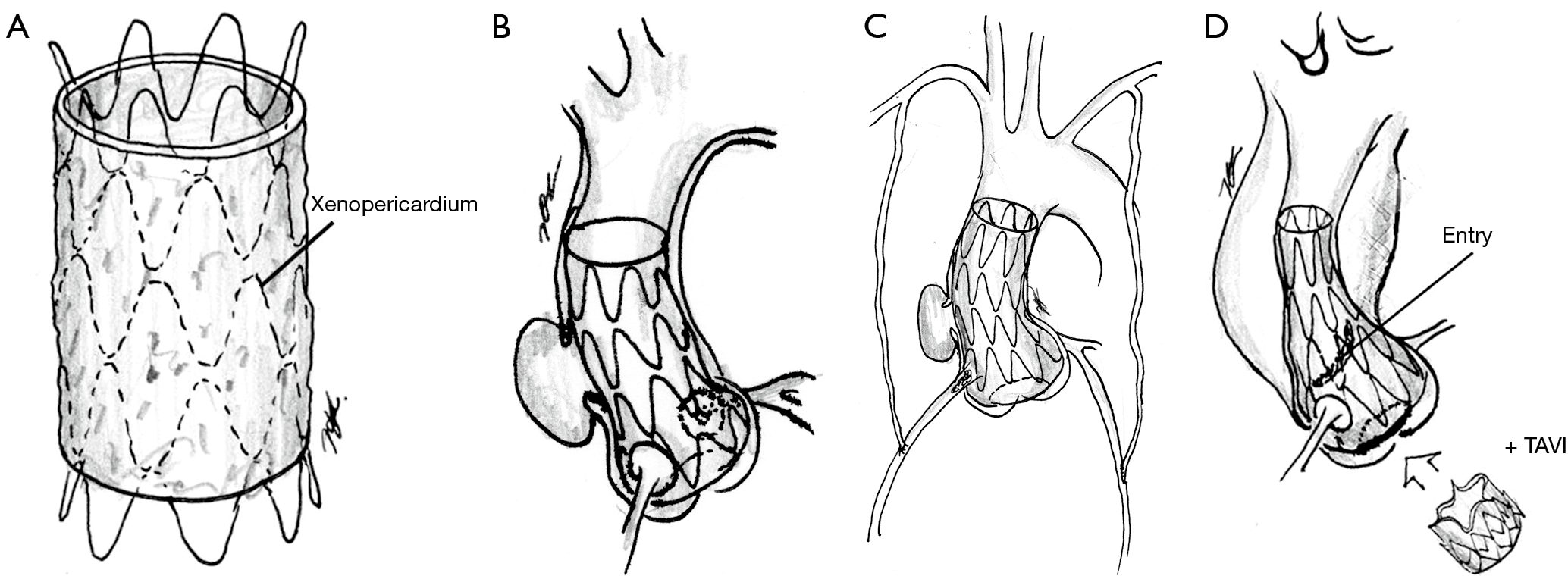 Endovascular Stent Graft Repair Of The Ascending Aorta Final Frontier In The Endovascular Treatment Of The Aorta Kubota Journal Of Thoracic Disease
