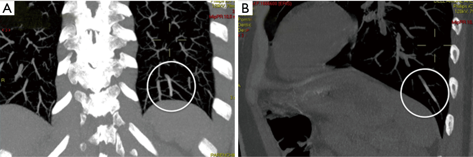 Peripheral venous catheter fracture with embolism into the pulmonary