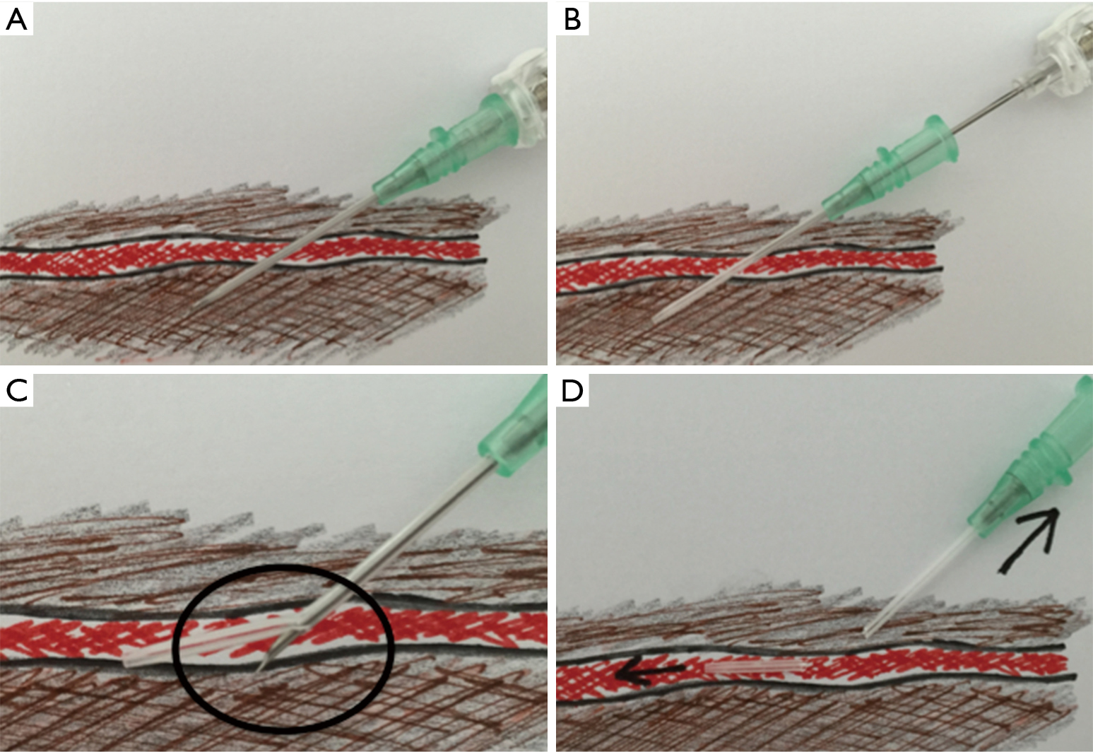 Peripheral venous catheter fracture with embolism into the pulmonary