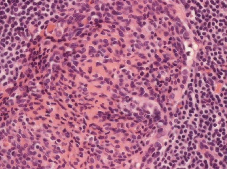 Clinical and pathological aspects of microscopic thymoma with