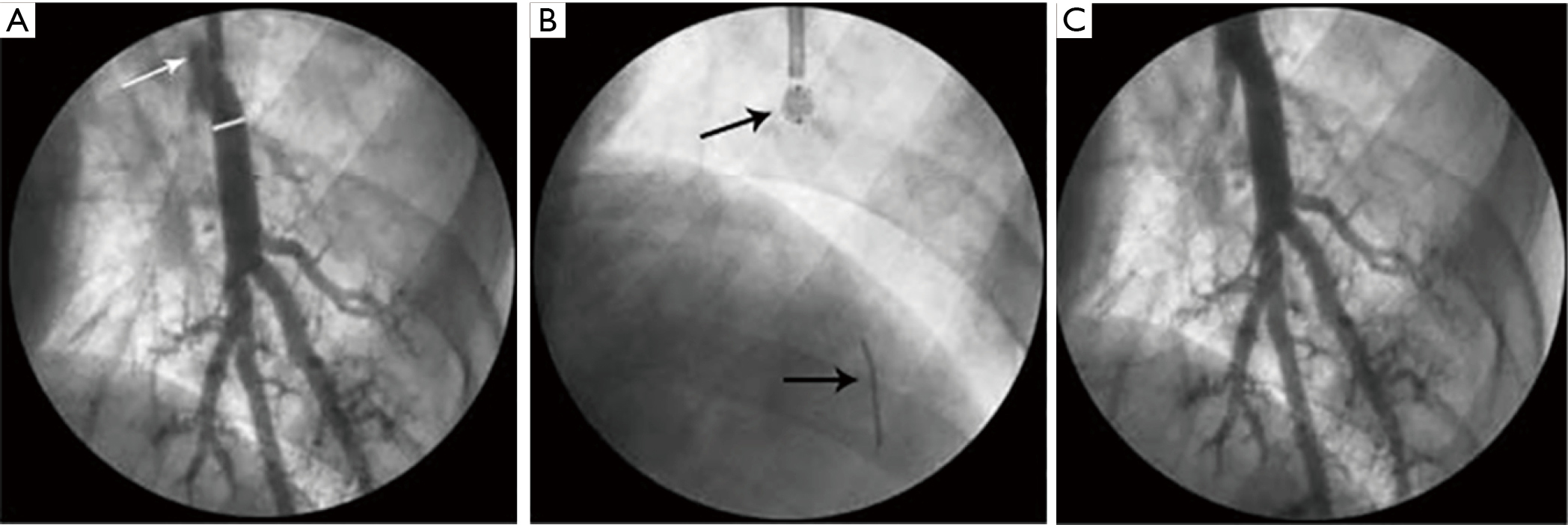 icd 10 pcs code for optical coherence tomography icd 10 pcs code for optical coherence tomography