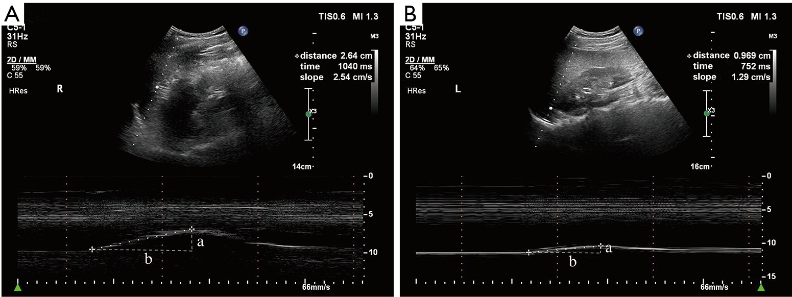 Using Mmode ultrasonography to assess diaphragm dysfunction and