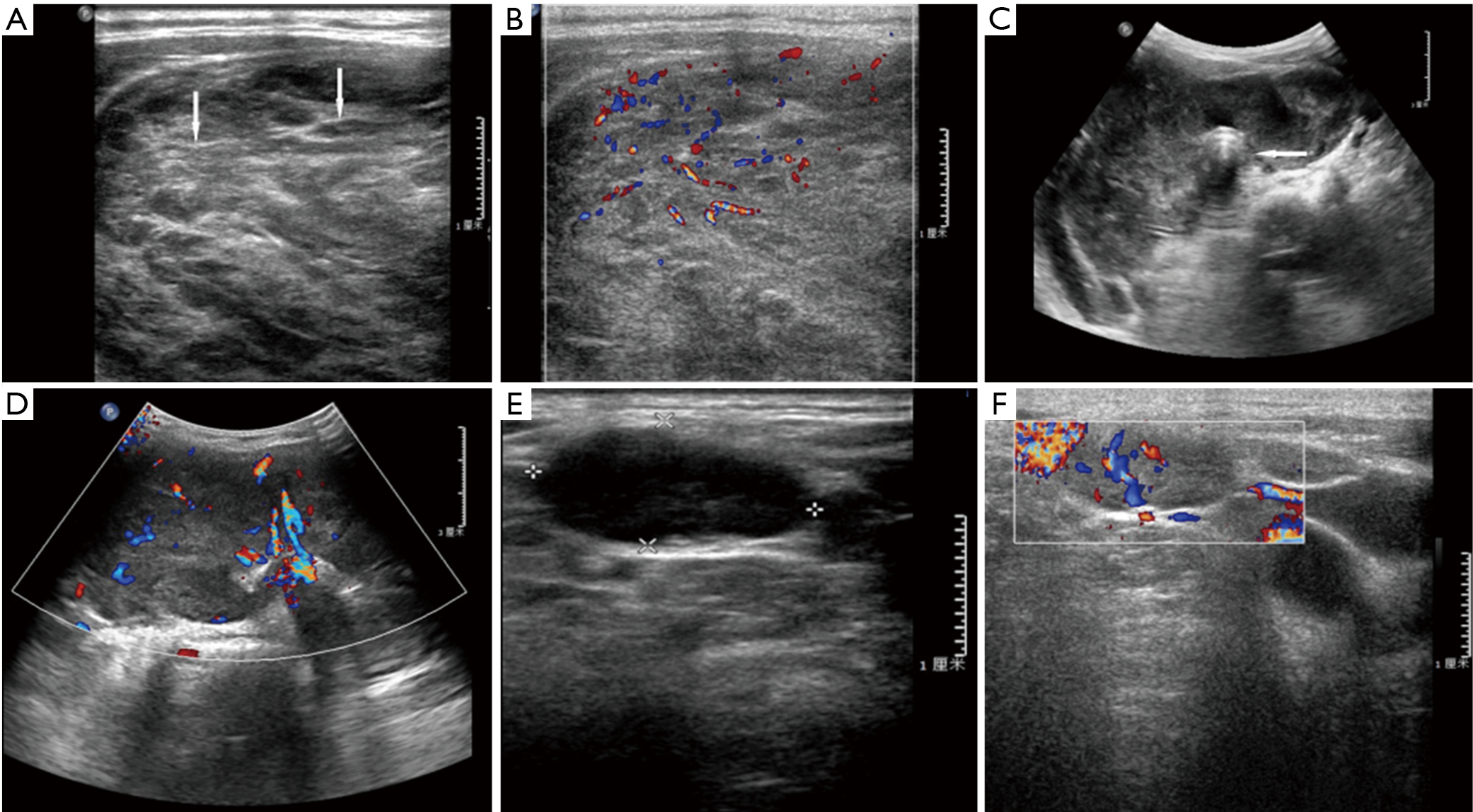 Comparison Of Sonographic Characteristics Of Primary Thyroid Lymphoma And Anaplastic Thyroid Carcinoma Gu Journal Of Thoracic Disease