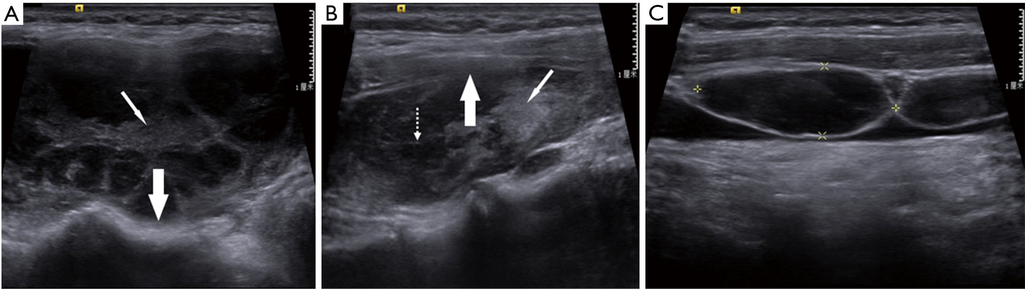 Comparison Of Sonographic Characteristics Of Primary Thyroid Lymphoma And Anaplastic Thyroid Carcinoma Gu Journal Of Thoracic Disease