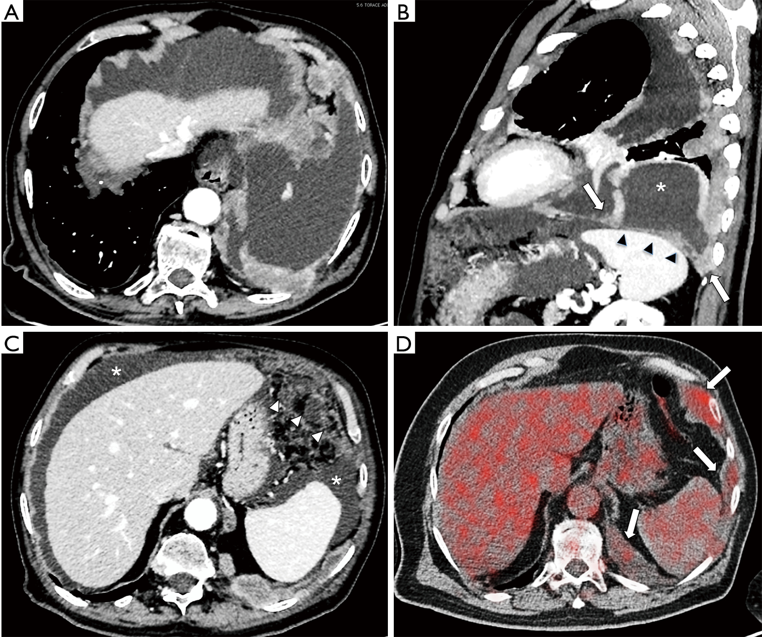 Clinical Diagnosis Of Malignant Pleural Mesothelioma Bianco Journal