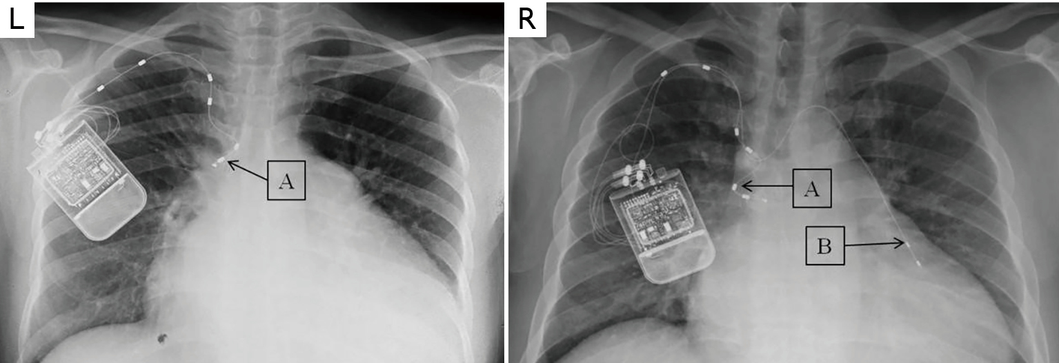 Transvenous phrenic nerve stimulation, a novel therapeutic approach for