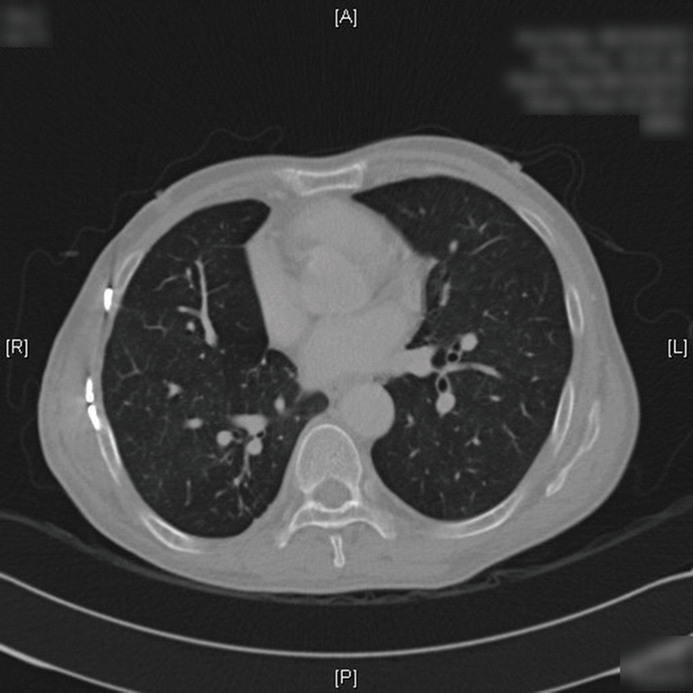 The painless combination of anatomically contoured titanium plates and porcine dermal collagen