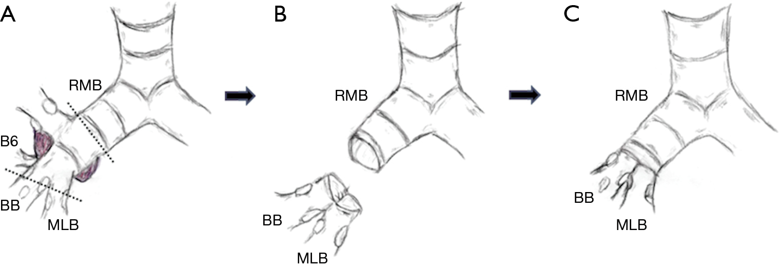 Extended right upper sleeve lobectomy with doublebarrel segmental