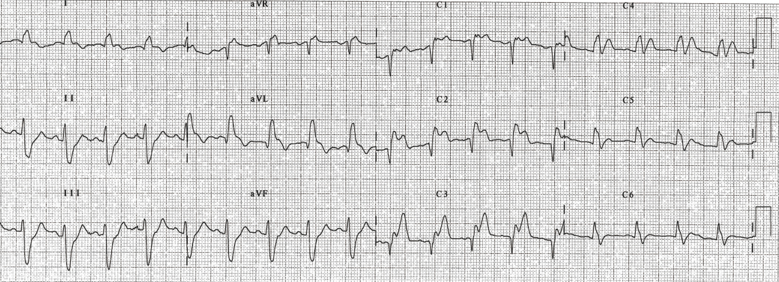 Easy Clinical Ecg Criteria To Suspect Total Occlusion Of Left Main In Acute Coronary Syndrome Fiol Journal Of Thoracic Disease