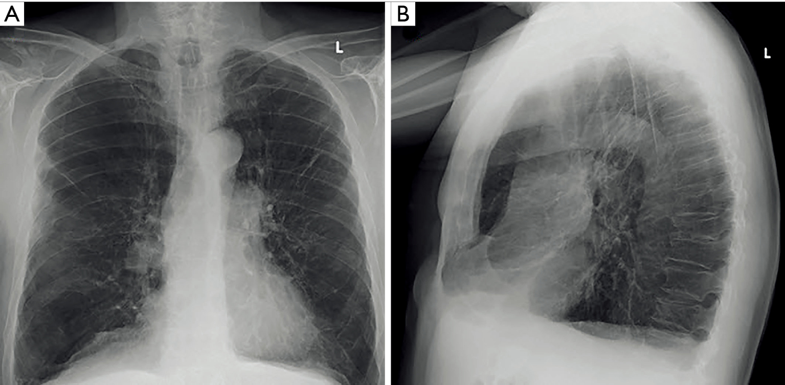 Emphysema And Lung Volume Reduction The Role Of Radiology Martini Journal Of Thoracic Disease