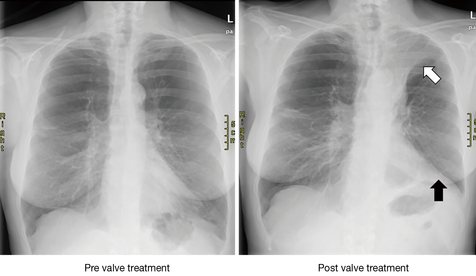Valve therapy in patients with emphysematous type of chronic