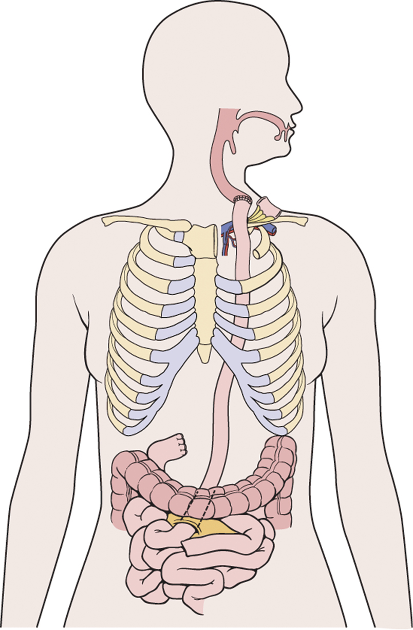 Jejunal graft conduits after esophagectomy Gaur Journal of Thoracic