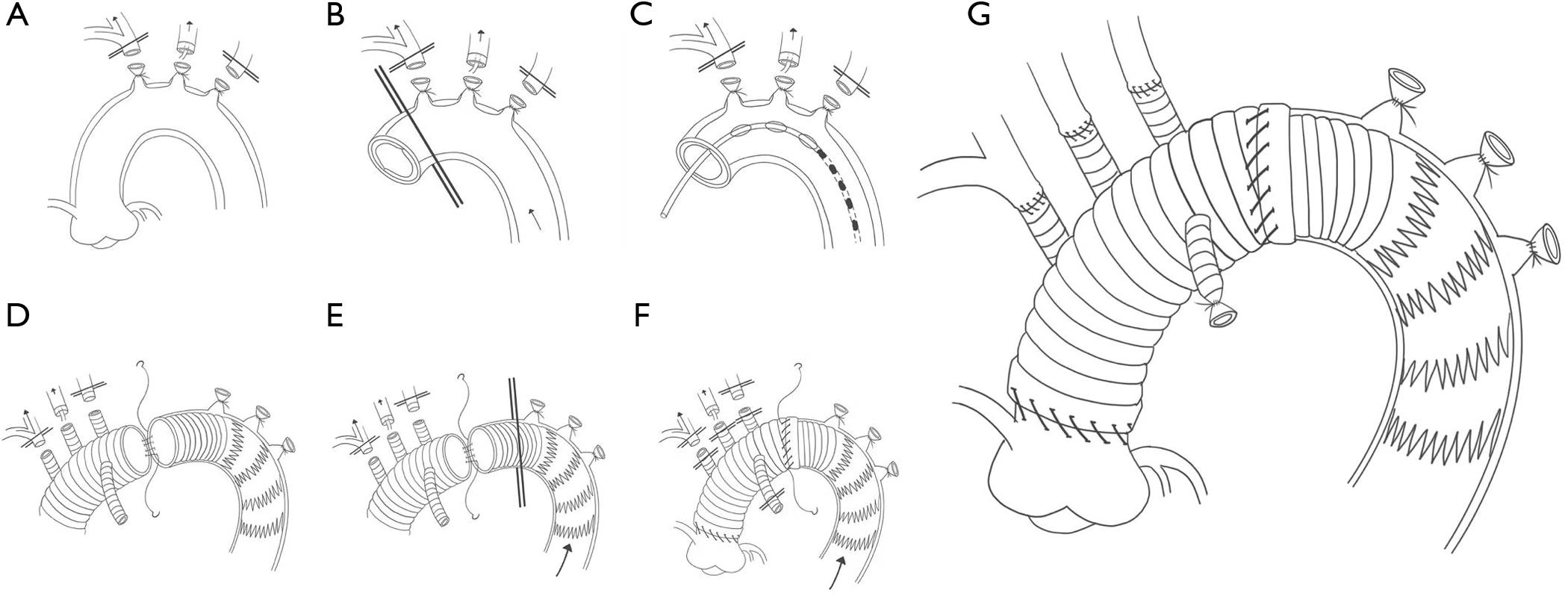 “Aortaclamp” technique for surgical repair of acute type A aortic