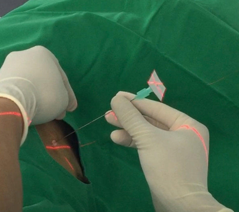Image Guided Video Assisted Thoracoscopic Surgery With Artis Pheno For Pulmonary Nodule Resection Cheng Journal Of Thoracic Disease