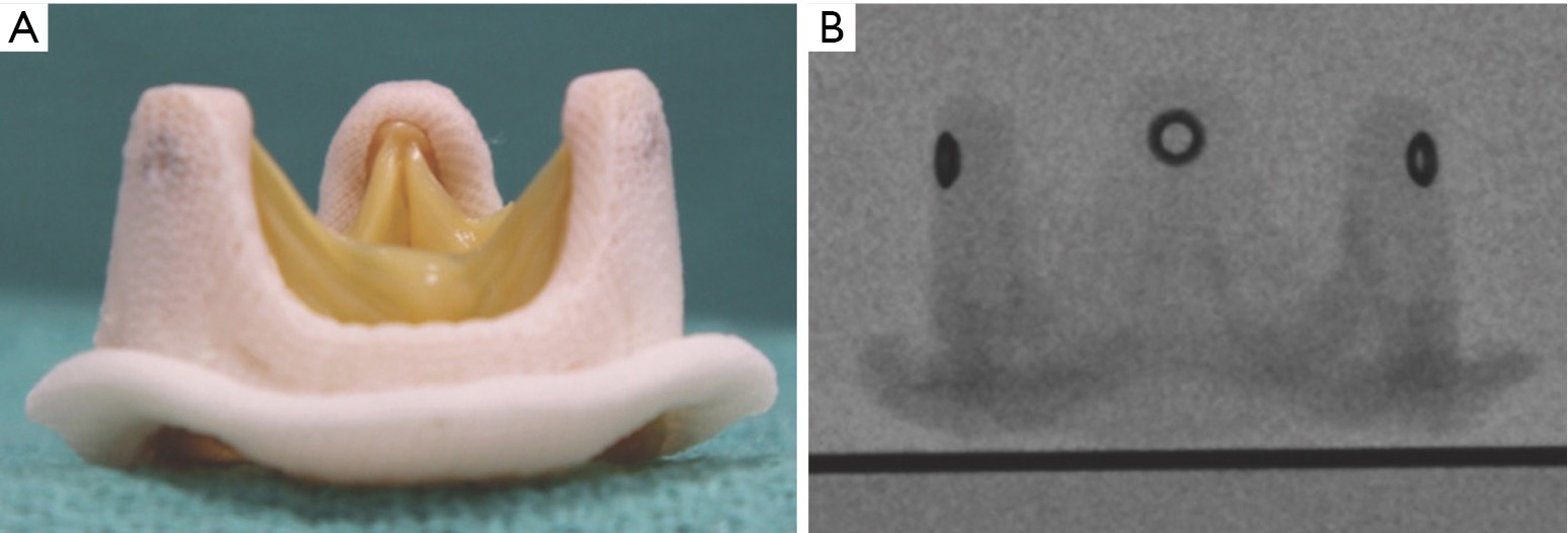 Challenges in valveinvalve therapy Noorani Journal of Thoracic Disease