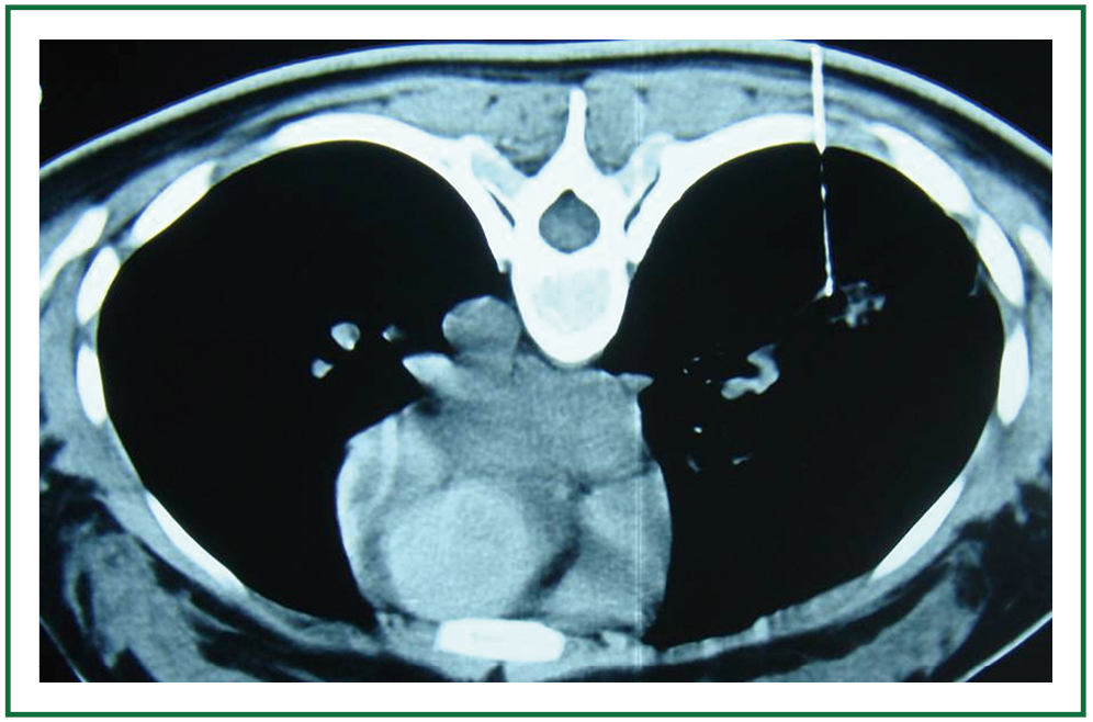 Perfusing chemotherapy by percutaneous lung puncture in the treatment