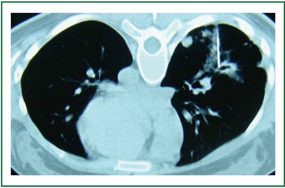 Perfusing chemotherapy by percutaneous lung puncture in the treatment