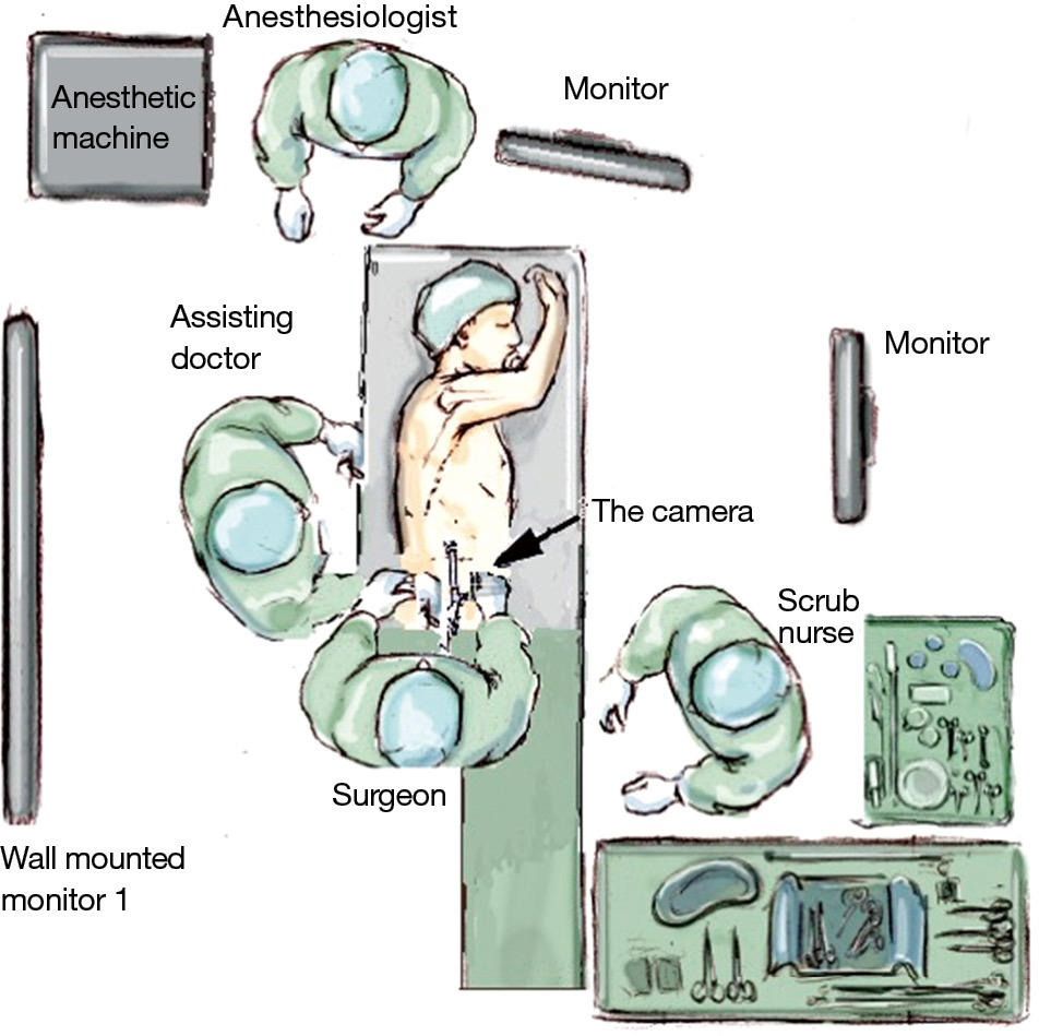 A new approach for videoassisted thoracoscopic lobectomy “the caudal