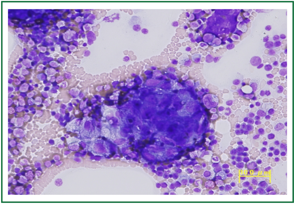 Breast Cancer Manifested By Hematologic Disorders Ishikawa Journal Of Thoracic Disease
