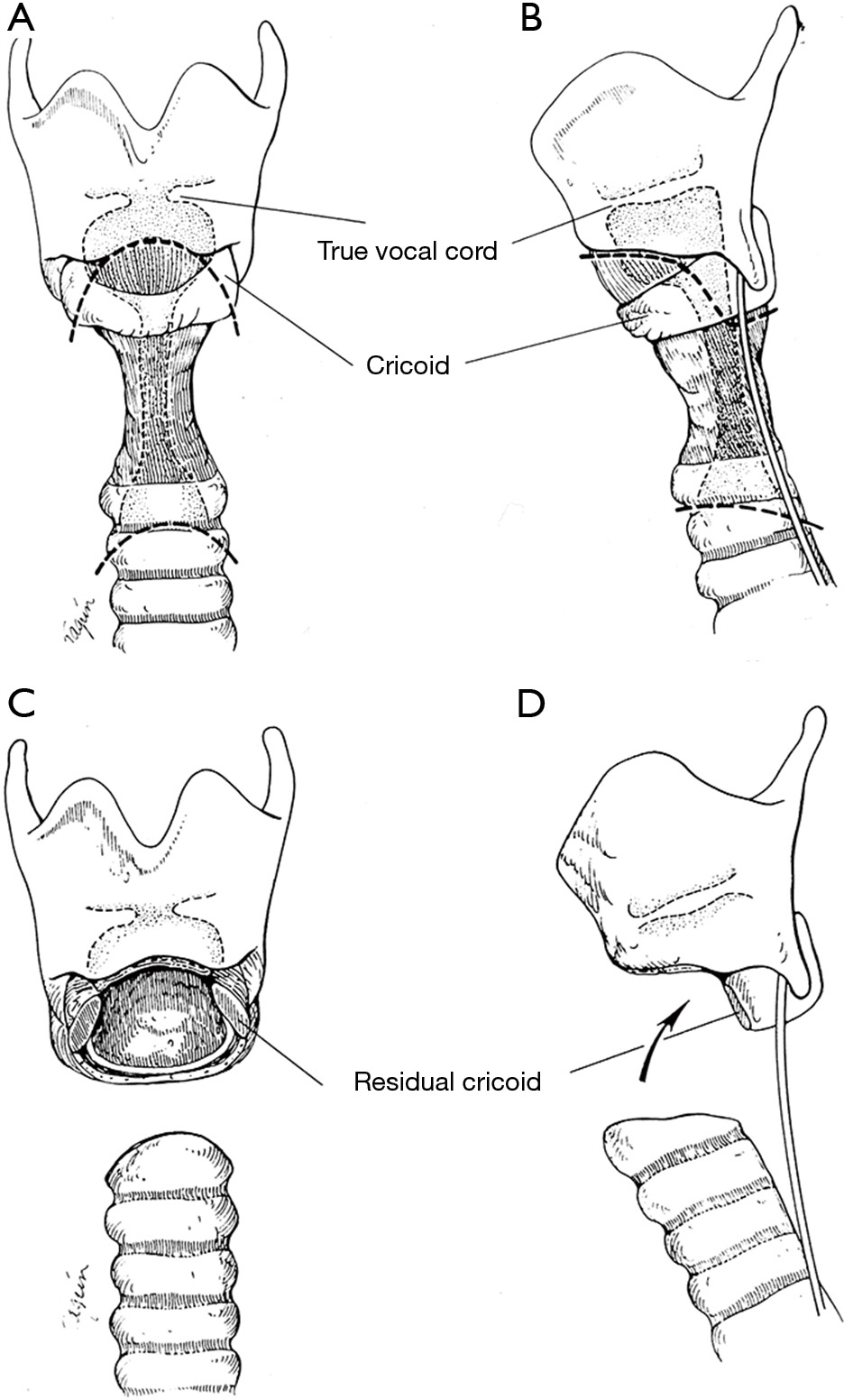 Idiopathic laryngotracheal stenosis Costantino Journal of Thoracic Disease