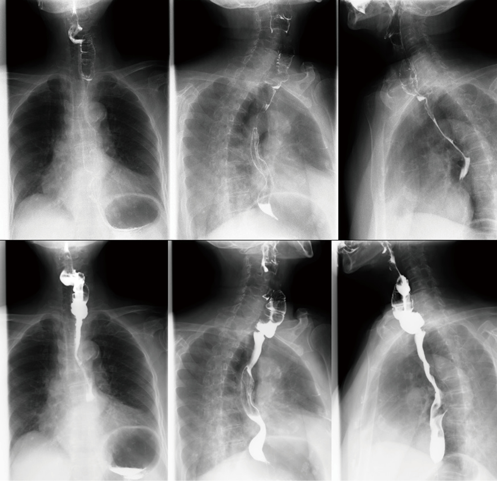 Free jejunum interposition as salvage surgery after cervical esophagus
