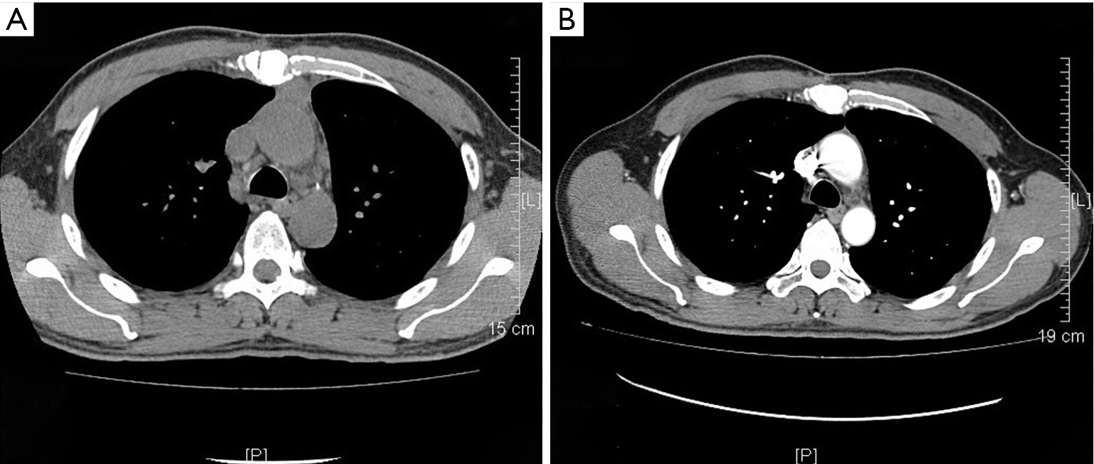An operated case of locally advanced thymic atypical carcinoid in