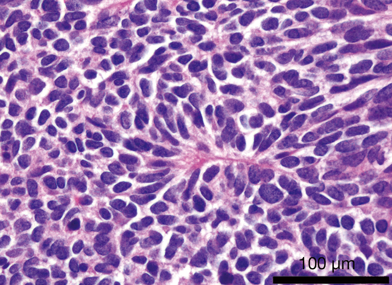 Histopathological Transformation To Small Cell Lung Carcinoma In Non Small Cell Lung Carcinoma Tumors Dorantes Heredia Translational Lung Cancer Research