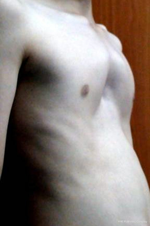 Open Repair Of Pectus Deformities Bostanci Shanghai Chest