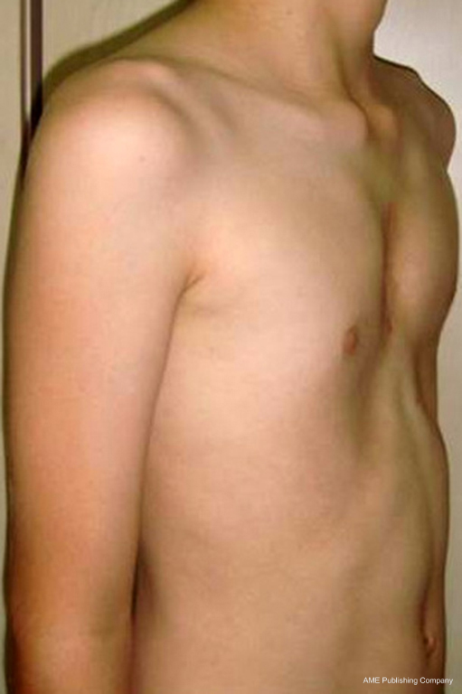 Open Repair Of Pectus Deformities Bostanci Shanghai Chest