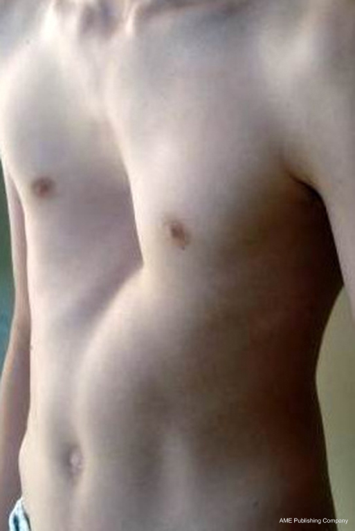 Open Repair Of Pectus Deformities Bostanci Shanghai Chest