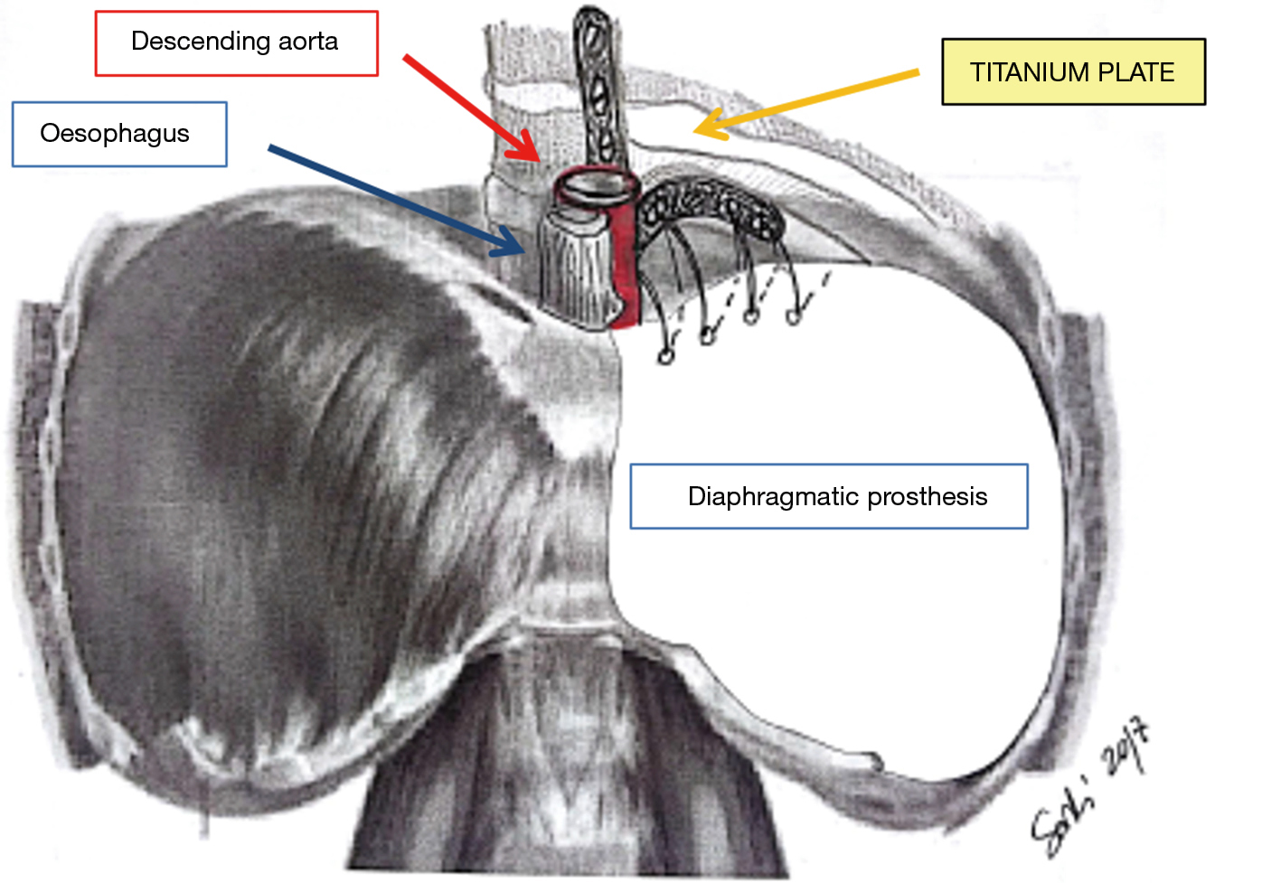 a new technique of diaphragmatic patch fixation in extrapleural