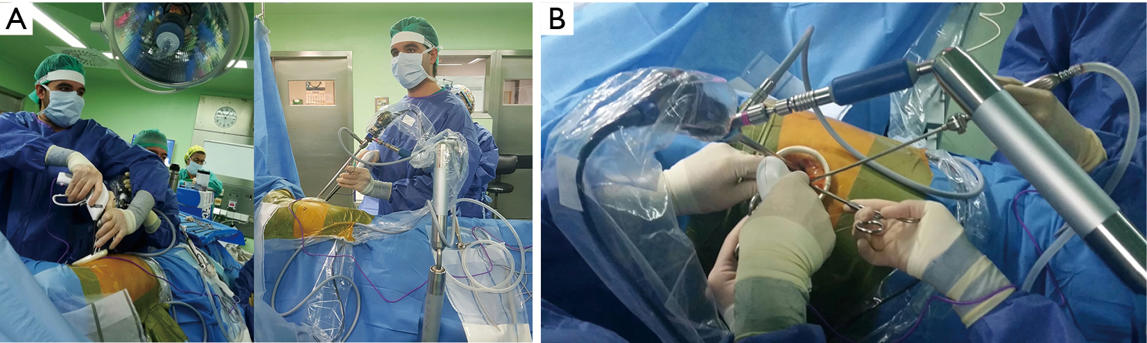 Video Assisted Thoracic Surgery Assisted By Articulated Arm Avats A New Way Towards Ergonomics And Optimization Of Surgical Resources Sesma Shanghai Chest