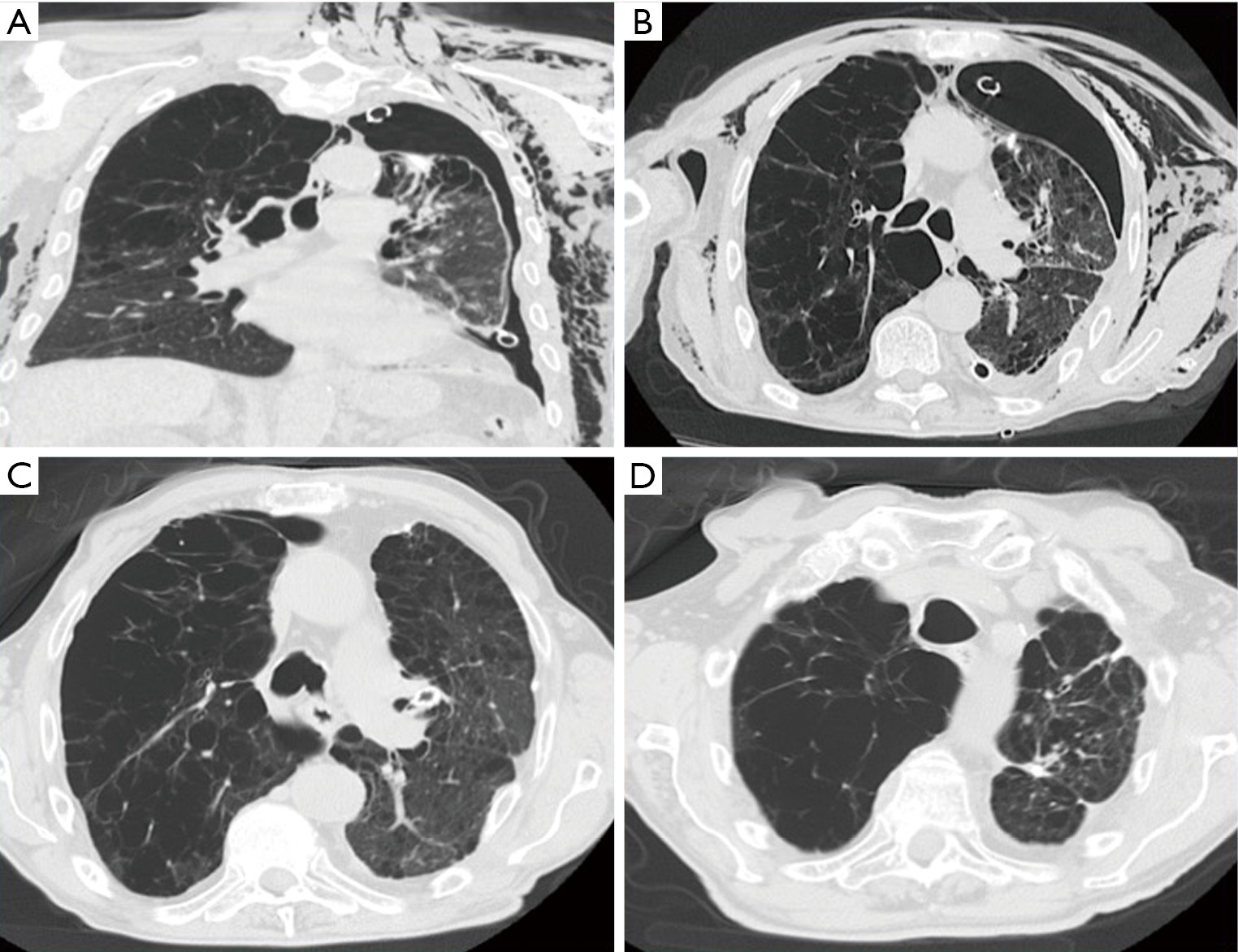 Endoscopic oneway endobronchial valves in the treatment of persistent