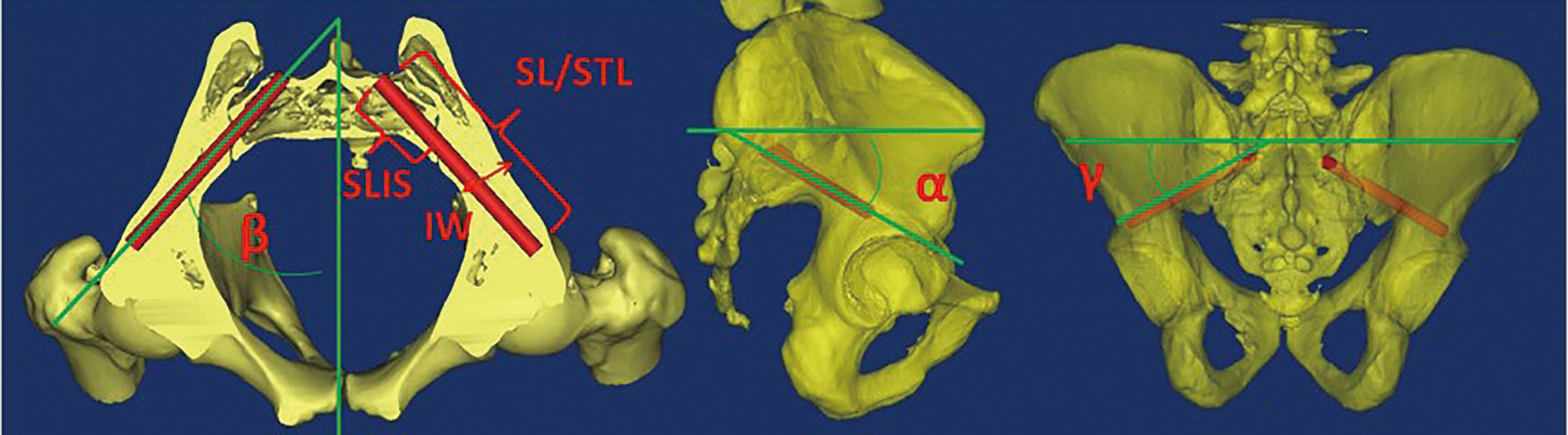 The Technique Of S2 Alar Iliac Screw Fixation A Literature Review Wu Ame Medical Journal