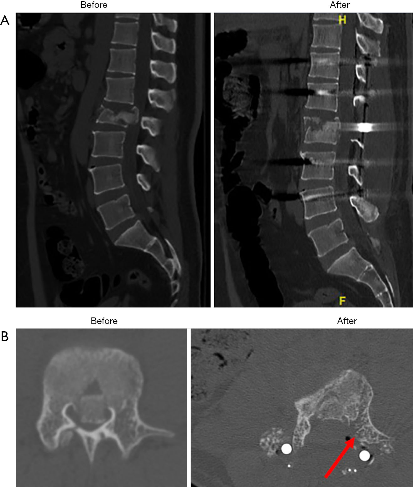 Surgical reduction technique (transpedicle) for unstable thoracolumbar