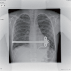 Chest radiography after the Nuss procedure. Four types of bar