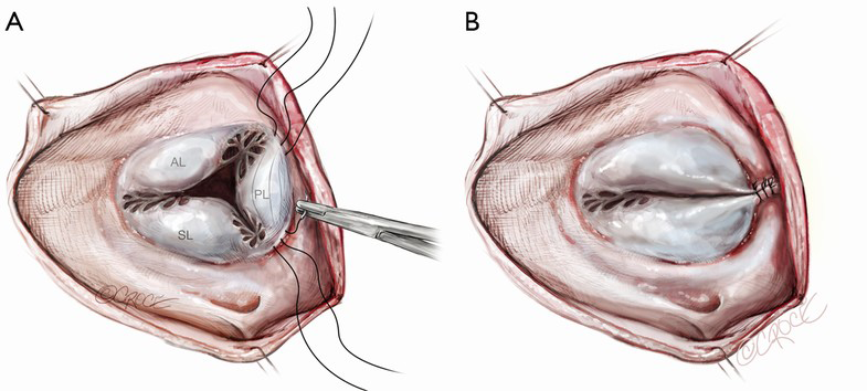 heart obliteration procedure